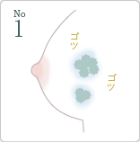 1位 しこり・石灰化
