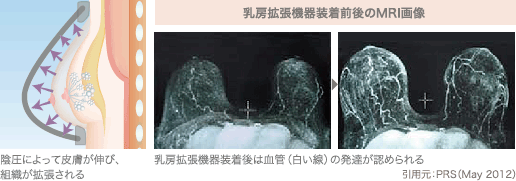 陰圧によって皮膚が伸び、組織が拡張される | 乳房拡張機器装着前後のMRI画像 / 乳房拡張機器装着後は血管(白い線)の発達が認められる (引用元:PRS(May 2012))